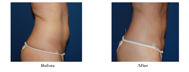 Smart Lipo Abs and Flanks - Tri-Cities - Kennewick, Pasco, and